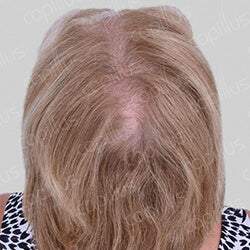 Capillus 312 Hair Laser