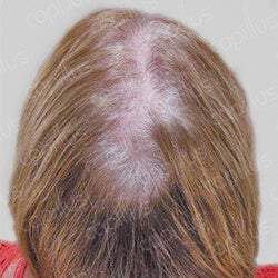 Capillus 312 Hair Laser