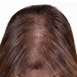 Capillus 312 Hair Laser