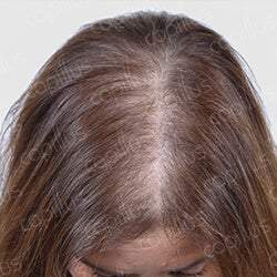 Capillus 312 Hair Laser